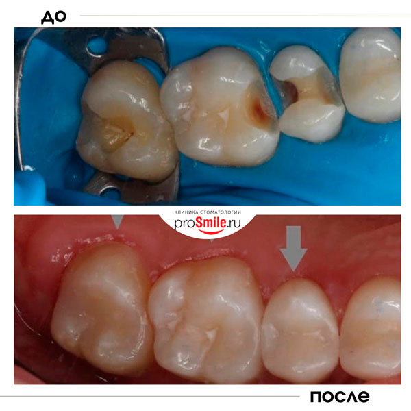 Лечение кариеса в стоматологии Просмайл.РУ